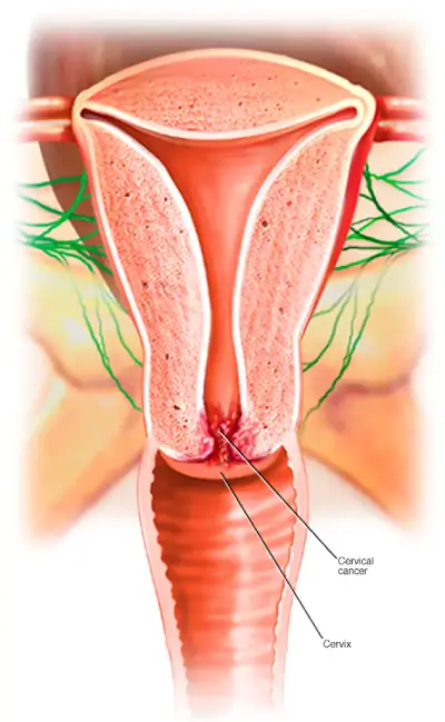 سرطان دهانه رحم