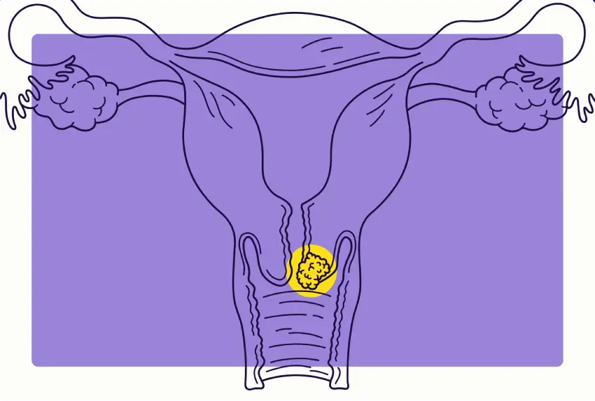 کنترل سرطان دهانه رحم
