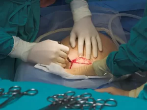 زایمان سزارین