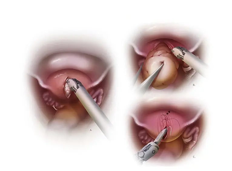 درمان فیبروم رحم