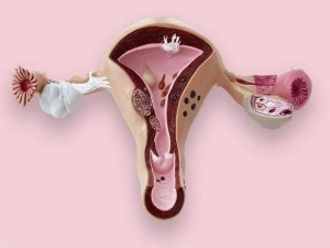 درمان پولیپ رحم