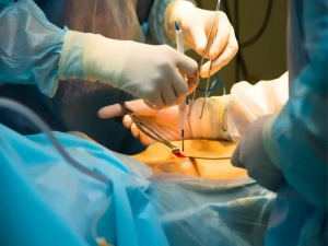 لاپاراسکوپی رحم