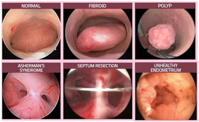 هیستروسکوپی رحم