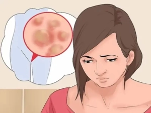 درمان زگیل تناسلی