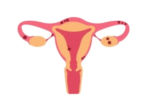 درمان اندومتریوز