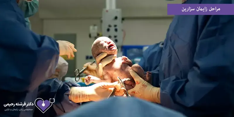 مراحل زایمان سزارین