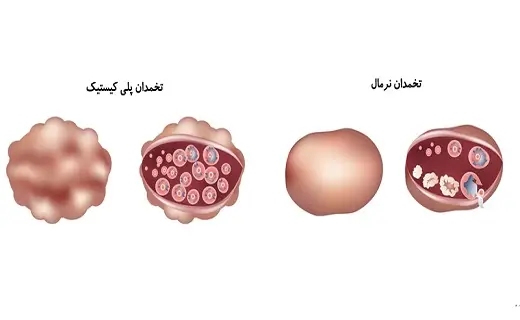 سندرم تخمدان پلی کیستیک