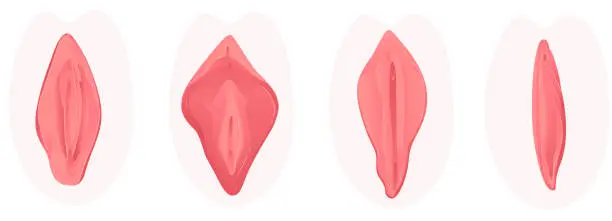 جراحی لابیاپلاستی