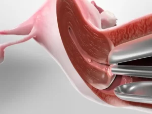 مراقبت های بعد هیستروسکوپی