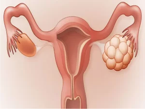 درمان تنبلی تخمدان