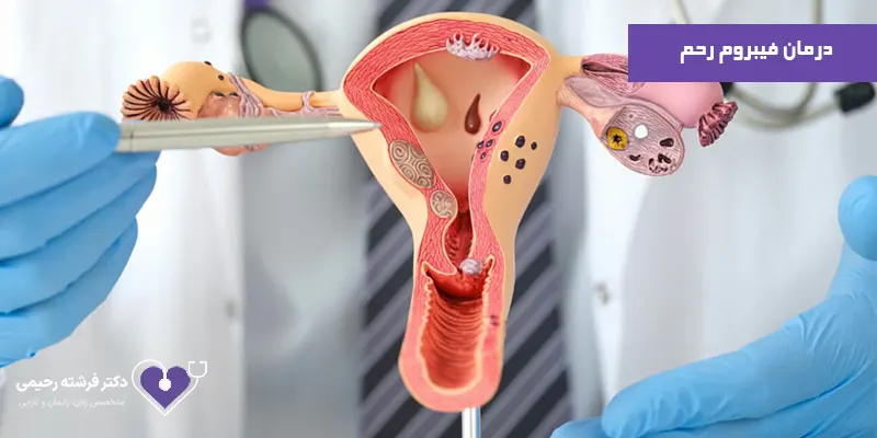 درمان-فیبروم-رحم