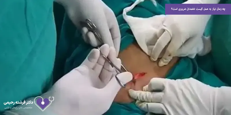 چه زمان نیاز به عمل کیست تخمدان ضروری است؟