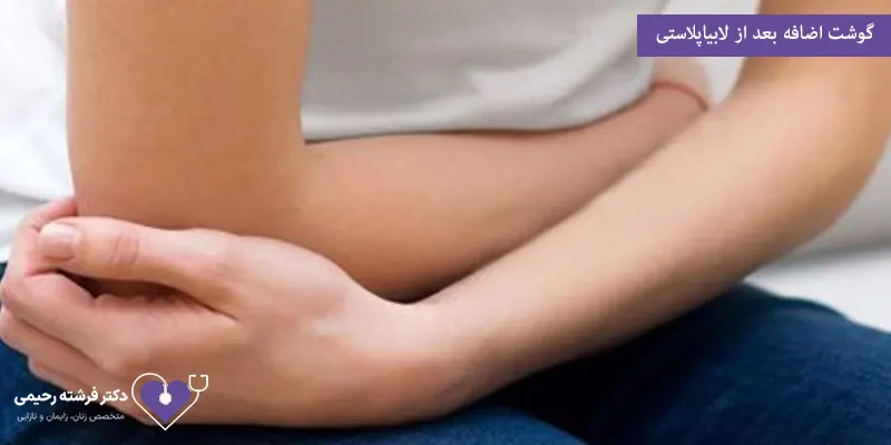 گوشت اضافه بعد از لابیاپلاستی