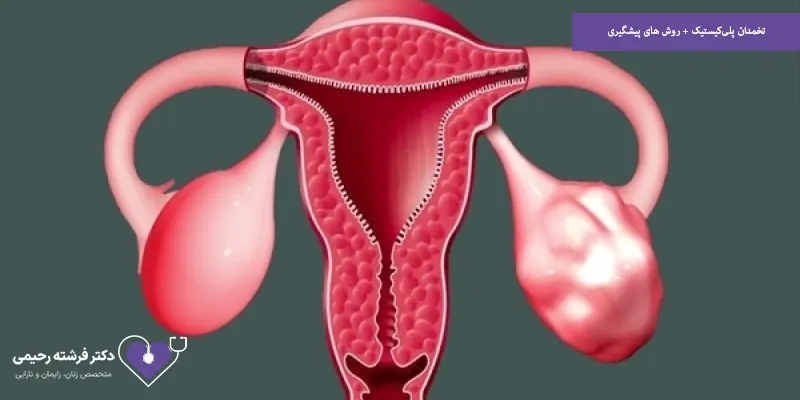 تخمدان پلی‌کیستیک + روش های پیشگیری