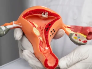 تنبلی تخمدان