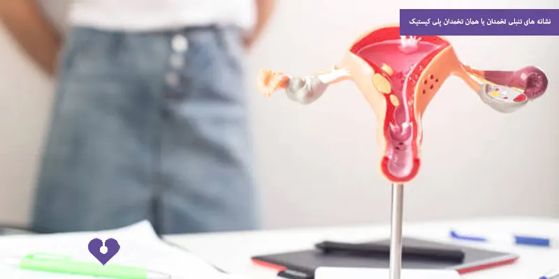 نشانه های تنبلی تخمدان یا همان تخمدان پلی کیستیک