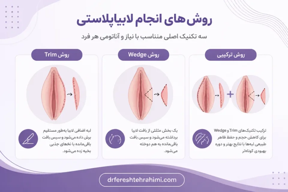 نمای توضیحی درباره روش های انجام لابیاپلاستی